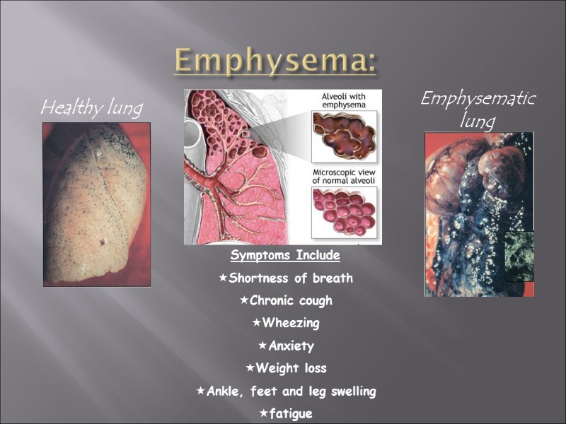 Emphysema:   Healthy lung Emphysematic lung Symptoms Include Shortness of breath Chronic cough